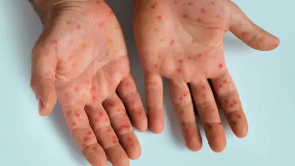 WHO Tetapkan Mpox Sebagai Darurat Kesehatan Global, Kasus Meningkat di Indonesia